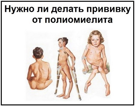 Полиомиелит.